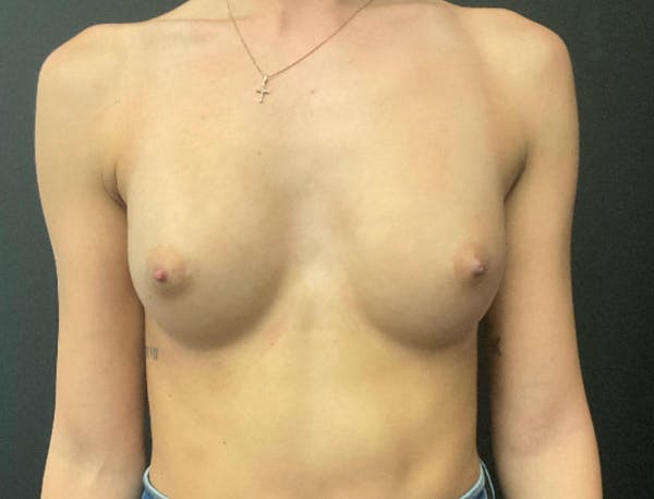 Breast Augmentation Before & After Gallery - Patient 281873 - Image 2