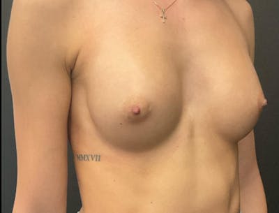 Breast Augmentation Before & After Gallery - Patient 281873 - Image 6