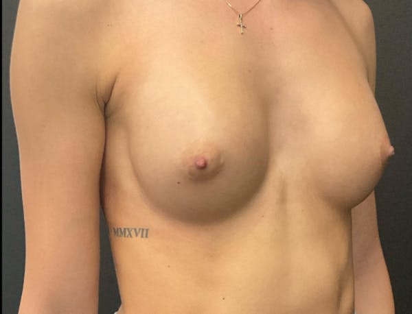 Breast Augmentation Before & After Gallery - Patient 281873 - Image 6