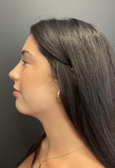 Chin Augmentation Before & After Gallery - Patient 372462 - Image 2