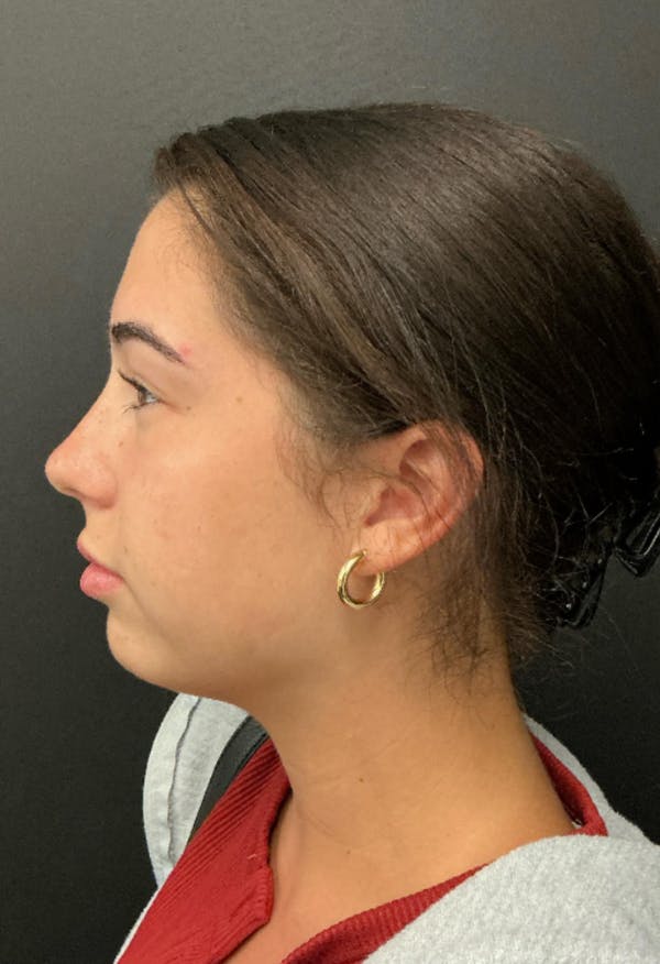 Chin Augmentation Before & After Gallery - Patient 372462 - Image 1