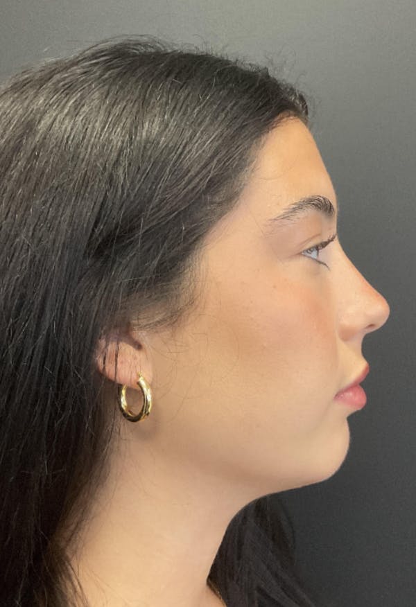 Chin Augmentation Before & After Gallery - Patient 372462 - Image 4