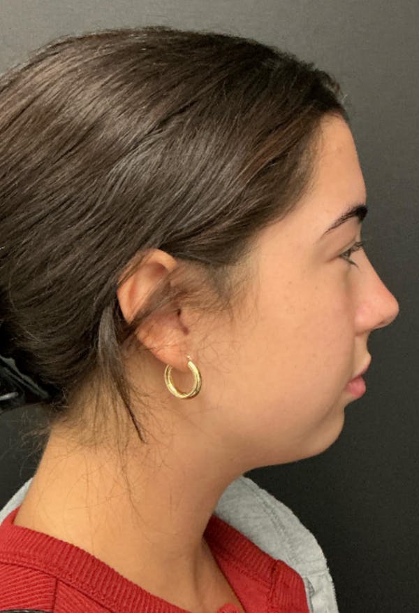 Chin Augmentation Before & After Gallery - Patient 372462 - Image 3