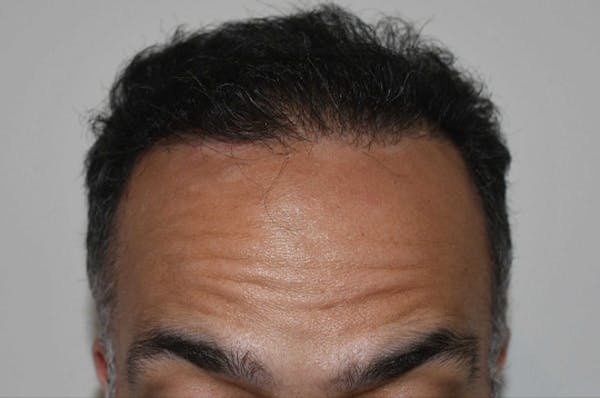 Hair Transplant Before & After Gallery - Patient 123356 - Image 2