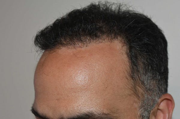 Hair Transplant Before & After Gallery - Patient 123356 - Image 6