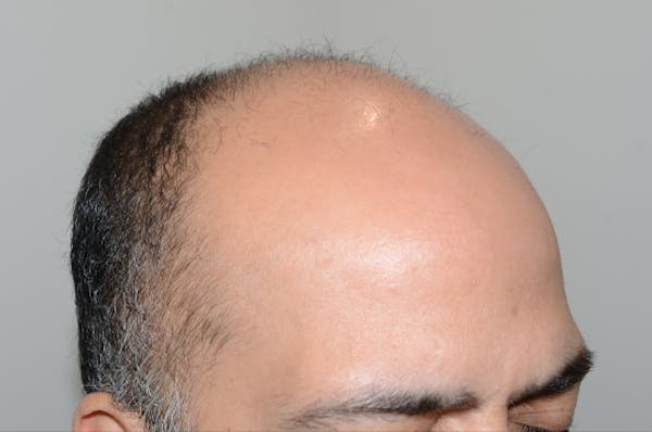 Hair Transplant Before & After Gallery - Patient 123356 - Image 3