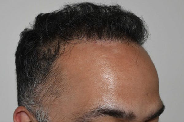 Hair Transplant Before & After Gallery - Patient 123356 - Image 4