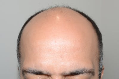 Hair Transplant Before & After Gallery - Patient 123356 - Image 1