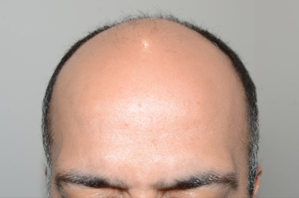Hair Transplant Before & After Gallery - Patient 123356 - Image 1
