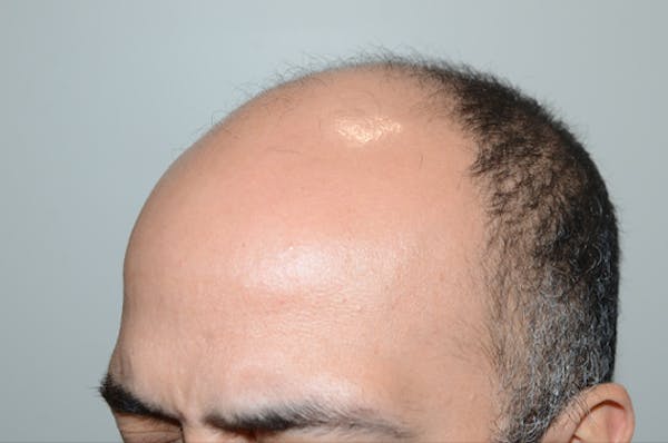 Hair Transplant Before & After Gallery - Patient 123356 - Image 5