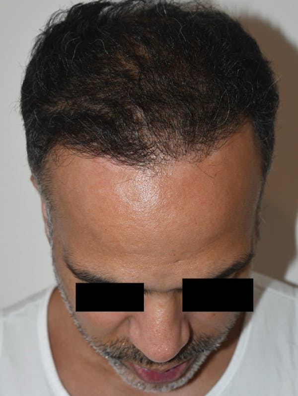 Hair Transplant Before & After Gallery - Patient 123356 - Image 8