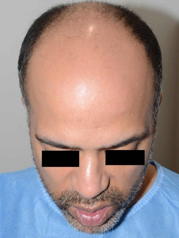 Hair Transplant Before & After Gallery - Patient 123356 - Image 7