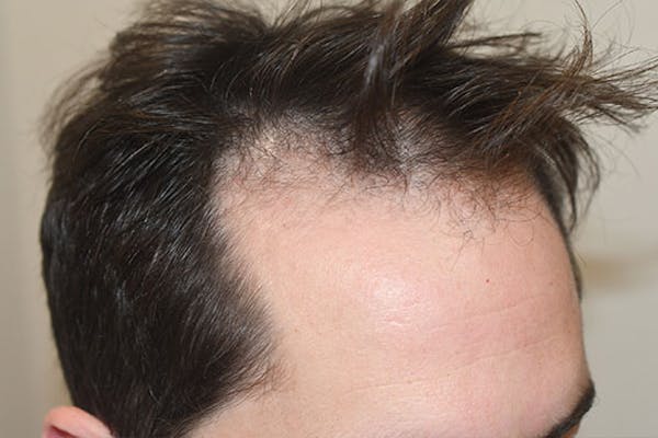 Hair Transplant Before & After Gallery - Patient 107173 - Image 5