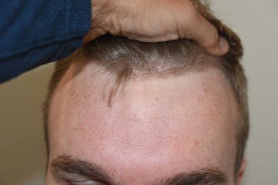 Hair Transplant Before & After Gallery - Patient 688635 - Image 1