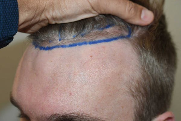 Hair Transplant Before & After Gallery - Patient 688635 - Image 3