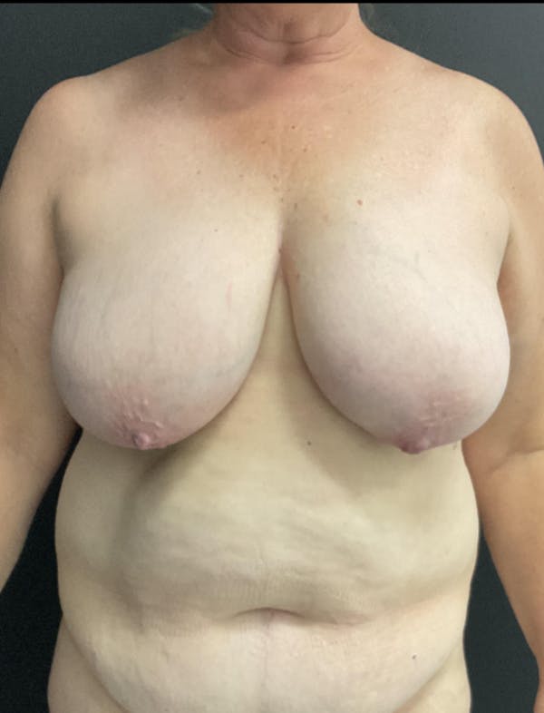 Breast Reduction Before & After Gallery - Patient 249345 - Image 1