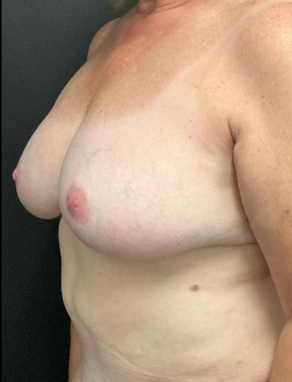 Breast Reduction Before & After Gallery - Patient 249345 - Image 4