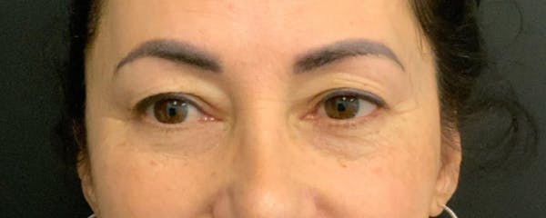 Blepharoplasty Before & After Gallery - Patient 744072 - Image 1