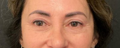 Blepharoplasty Before & After Gallery - Patient 744072 - Image 2