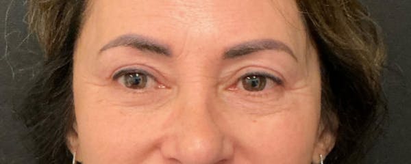 Blepharoplasty Before & After Gallery - Patient 744072 - Image 2