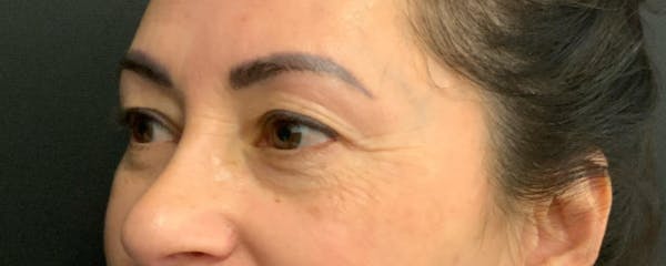 Blepharoplasty Before & After Gallery - Patient 744072 - Image 3