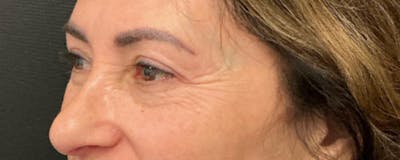 Blepharoplasty Before & After Gallery - Patient 744072 - Image 4