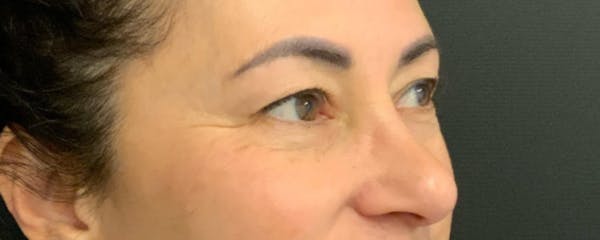 Blepharoplasty Before & After Gallery - Patient 744072 - Image 5