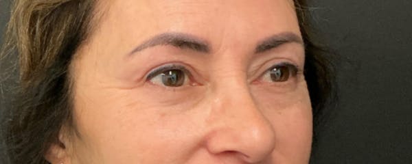 Blepharoplasty Before & After Gallery - Patient 744072 - Image 6