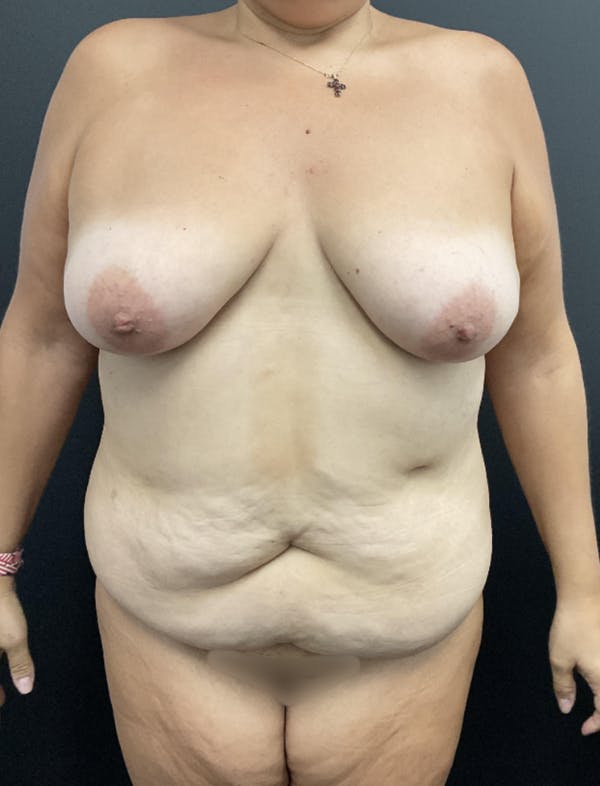 Mommy Makeover Before & After Gallery - Patient 419866 - Image 1