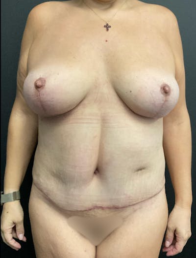 Mommy Makeover Before & After Gallery - Patient 419866 - Image 2