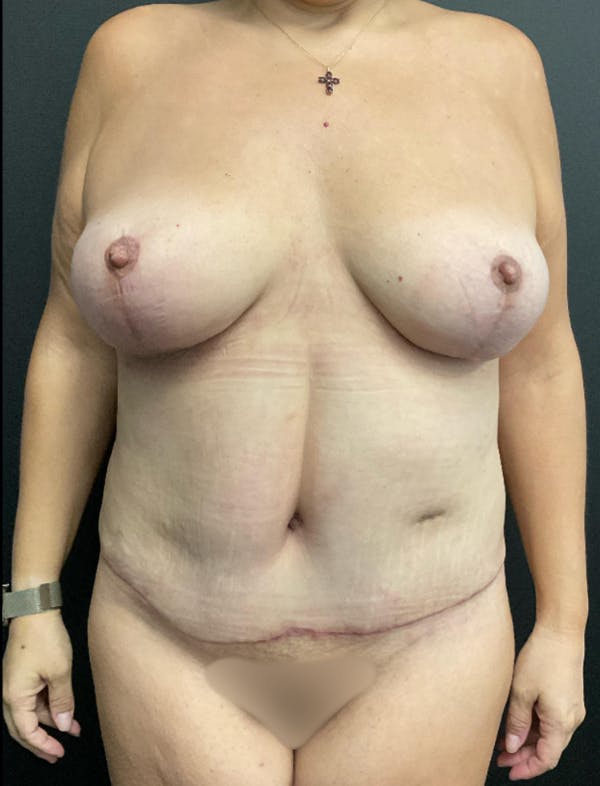 Mommy Makeover Before & After Gallery - Patient 419866 - Image 2