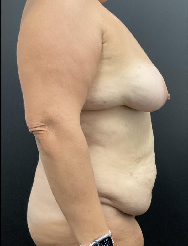 Mommy Makeover Before & After Gallery - Patient 419866 - Image 3