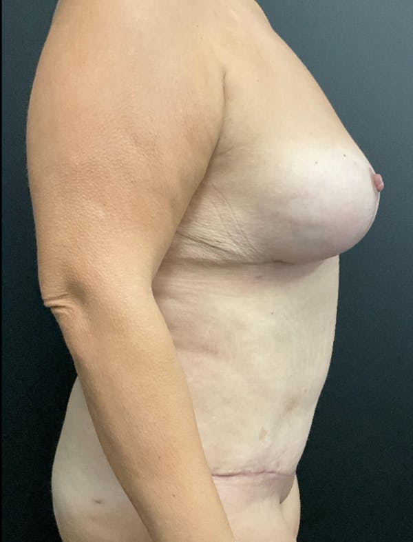 Mommy Makeover Before & After Gallery - Patient 419866 - Image 4