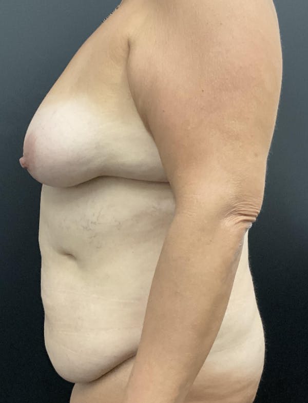 Mommy Makeover Before & After Gallery - Patient 419866 - Image 5