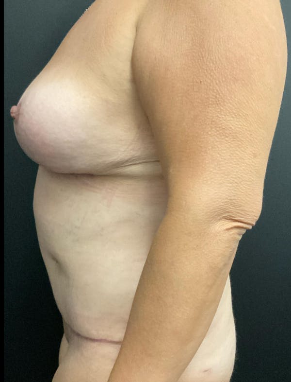 Mommy Makeover Before & After Gallery - Patient 419866 - Image 6