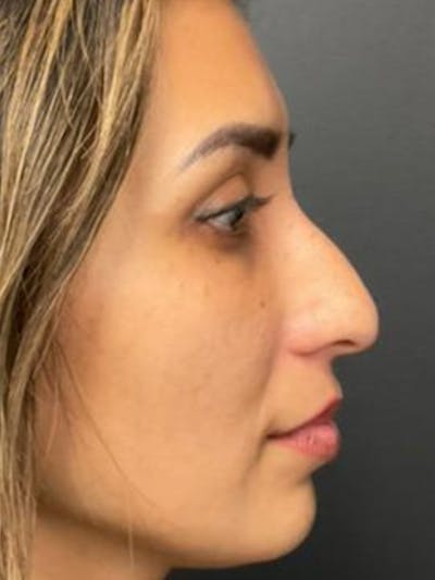 Rhinoplasty Before & After Gallery - Patient 254752 - Image 1