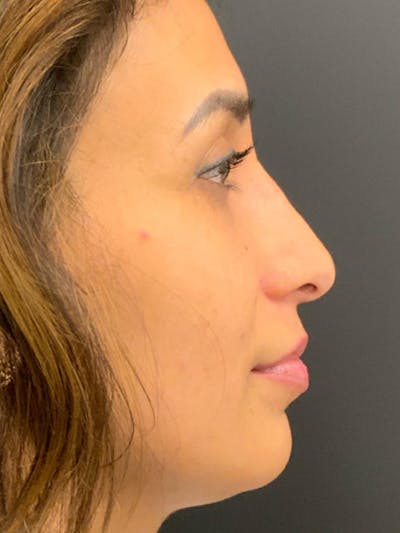Rhinoplasty Before & After Gallery - Patient 254752 - Image 2
