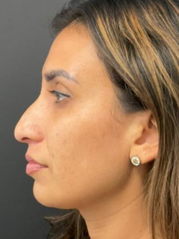 Rhinoplasty Before & After Gallery - Patient 254752 - Image 3
