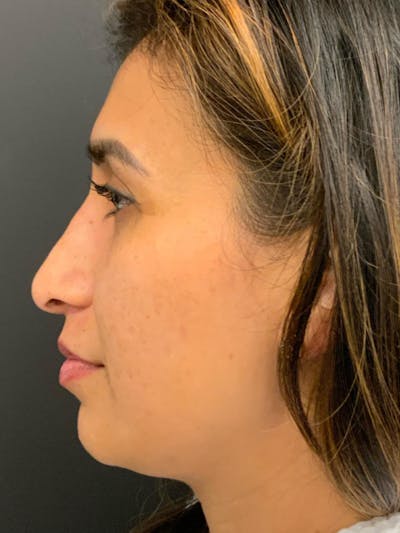 Rhinoplasty Before & After Gallery - Patient 254752 - Image 4
