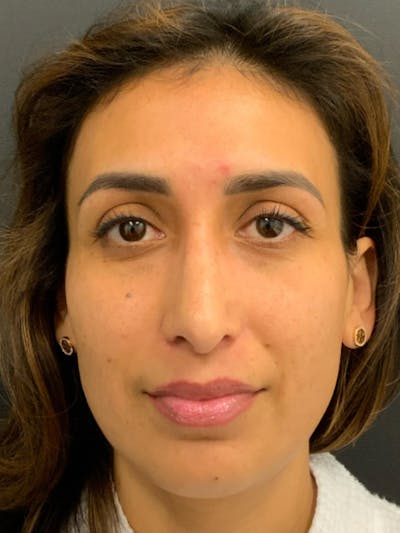 Rhinoplasty Before & After Gallery - Patient 254752 - Image 6