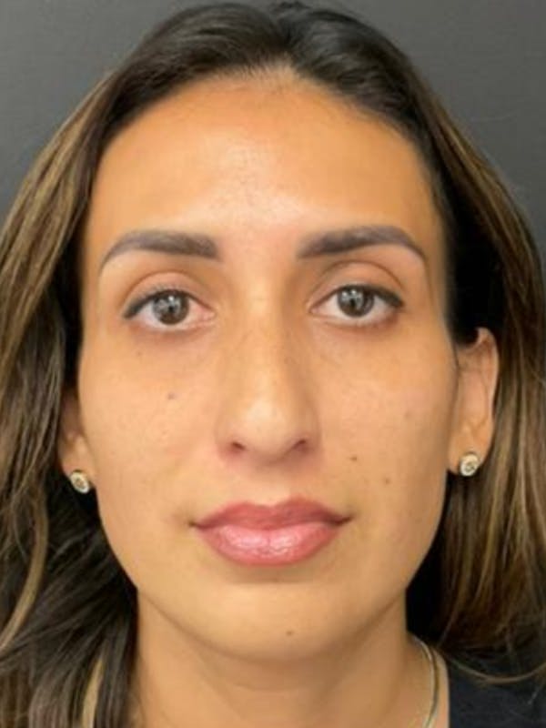 Rhinoplasty Before & After Gallery - Patient 254752 - Image 5