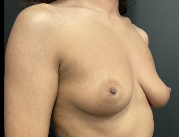 Breast Augmentation Before & After Gallery - Patient 264046 - Image 3