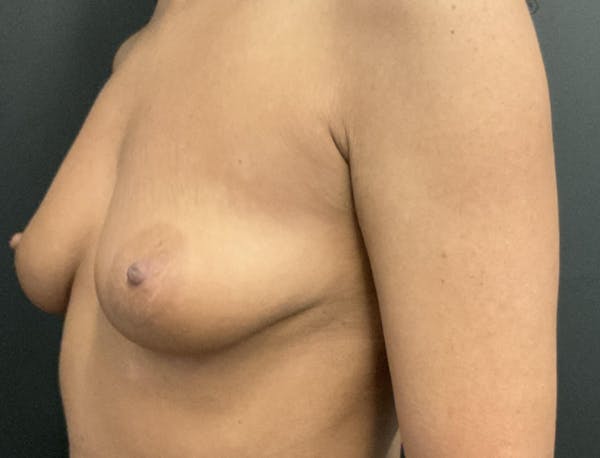 Breast Augmentation Before & After Gallery - Patient 264046 - Image 5