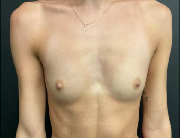 Breast Augmentation Before & After Gallery - Patient 648520 - Image 1