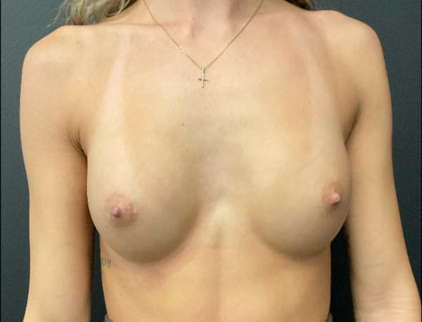Breast Augmentation Before & After Gallery - Patient 648520 - Image 2