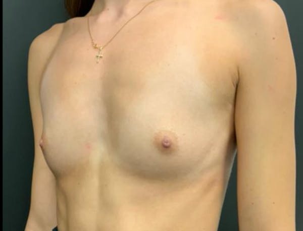 Breast Augmentation Before & After Gallery - Patient 648520 - Image 5