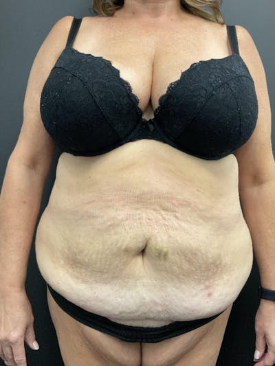 Tummy Tuck Before & After Gallery - Patient 414296 - Image 1