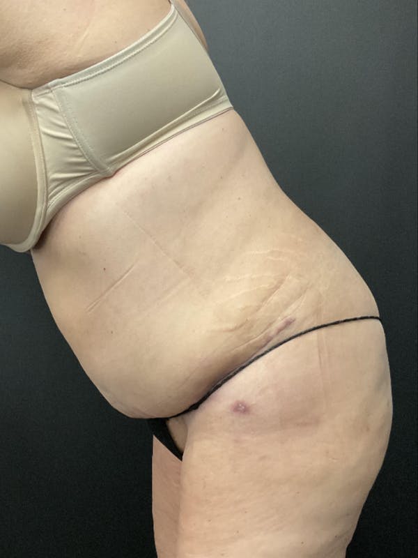 Tummy Tuck Before & After Gallery - Patient 414296 - Image 4