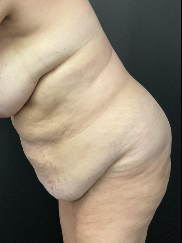 Tummy Tuck Before & After Gallery - Patient 414296 - Image 3