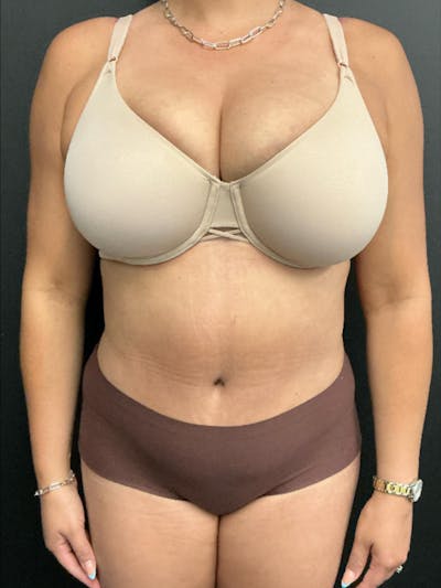 Tummy Tuck Before & After Gallery - Patient 123673 - Image 2